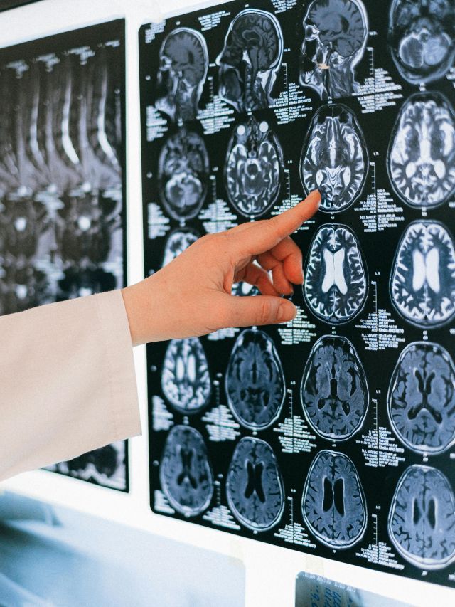 Anvisa aprova 1º tratamento que promete retardar Alzheimer