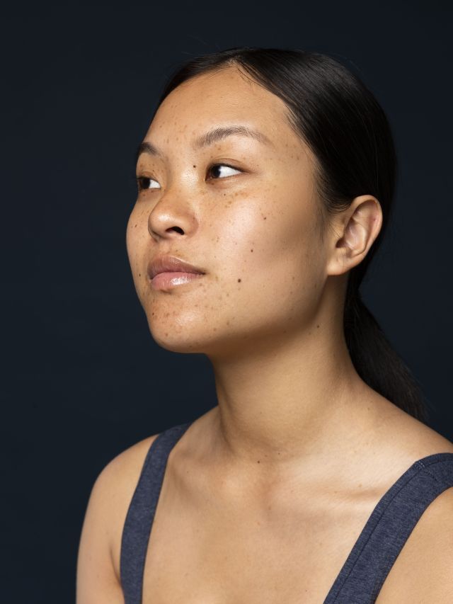 Melasma: saiba qual é a melhor rotina para clarear as manchas